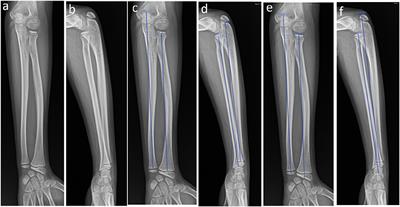 Characteristics of the length of the radius and ulna in children